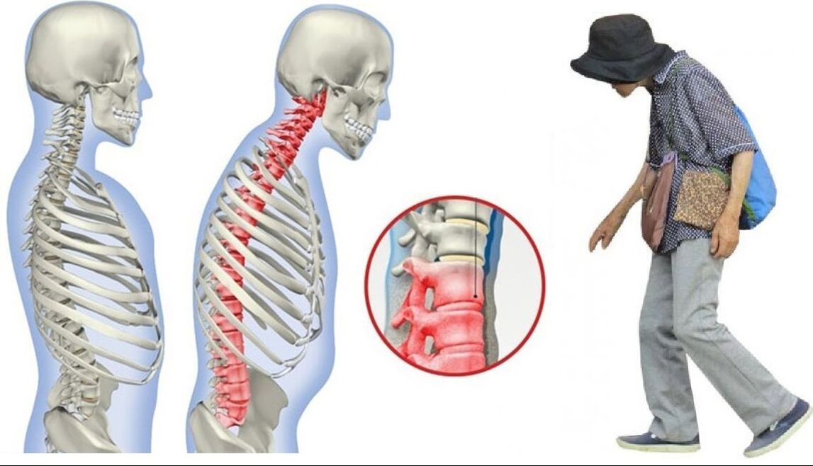 spondylitis ankylopoetica okozta hátfájás
