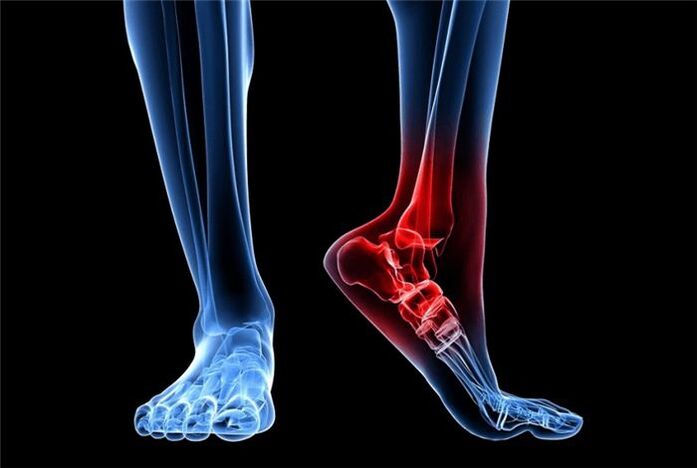 a láb arthrosisa