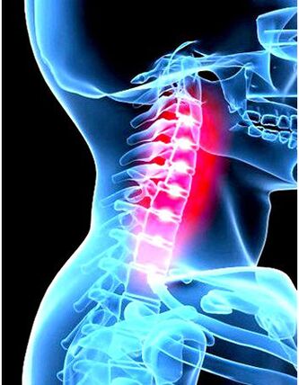 Az osteochondrosis klinikai képe