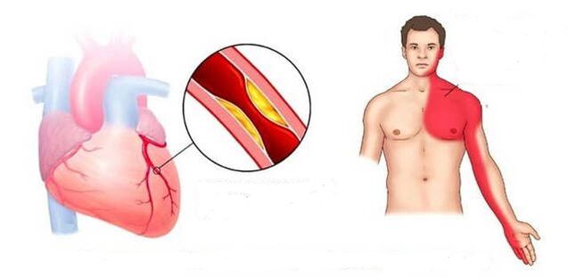 Cardialis szindróma